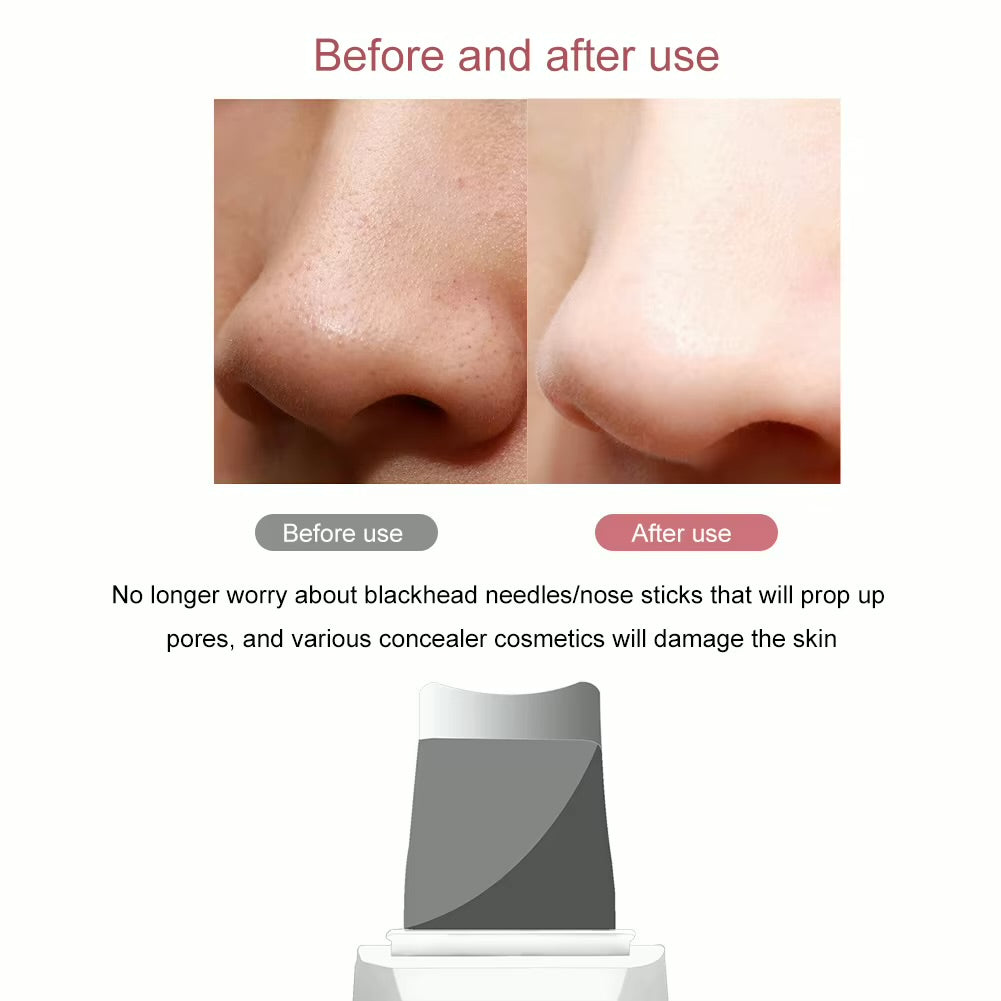 Ultrasonic Skin Scrubber – Deep Pore & Blackhead Cleaner