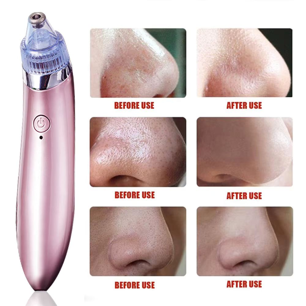 Vacuum Pore and Blackheads Cleaner – Deep Clean & Hydrate