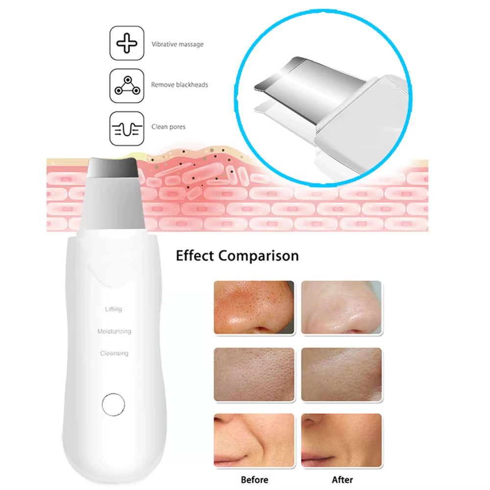 Ultrasonic Skin Scrubber – Deep Pore & Blackhead Cleaner